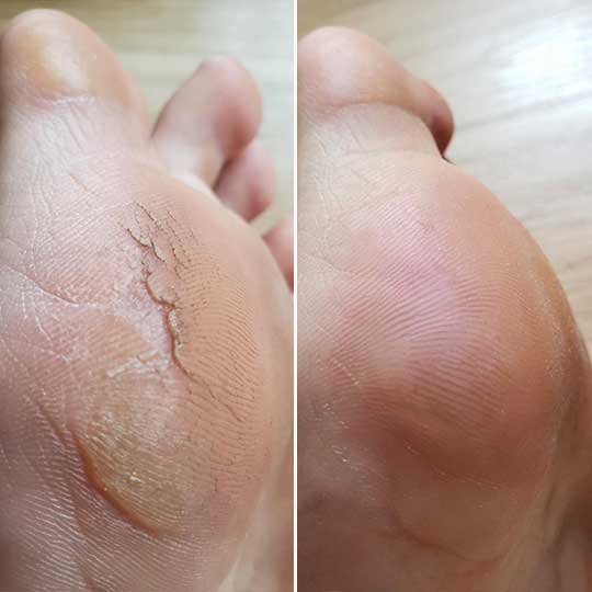 Efekt gładkich pięt po użyciu VelaGlow Pro - Anna D.